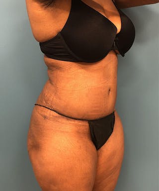 Powertuck Before & After Gallery - Patient 372566 - Image 4