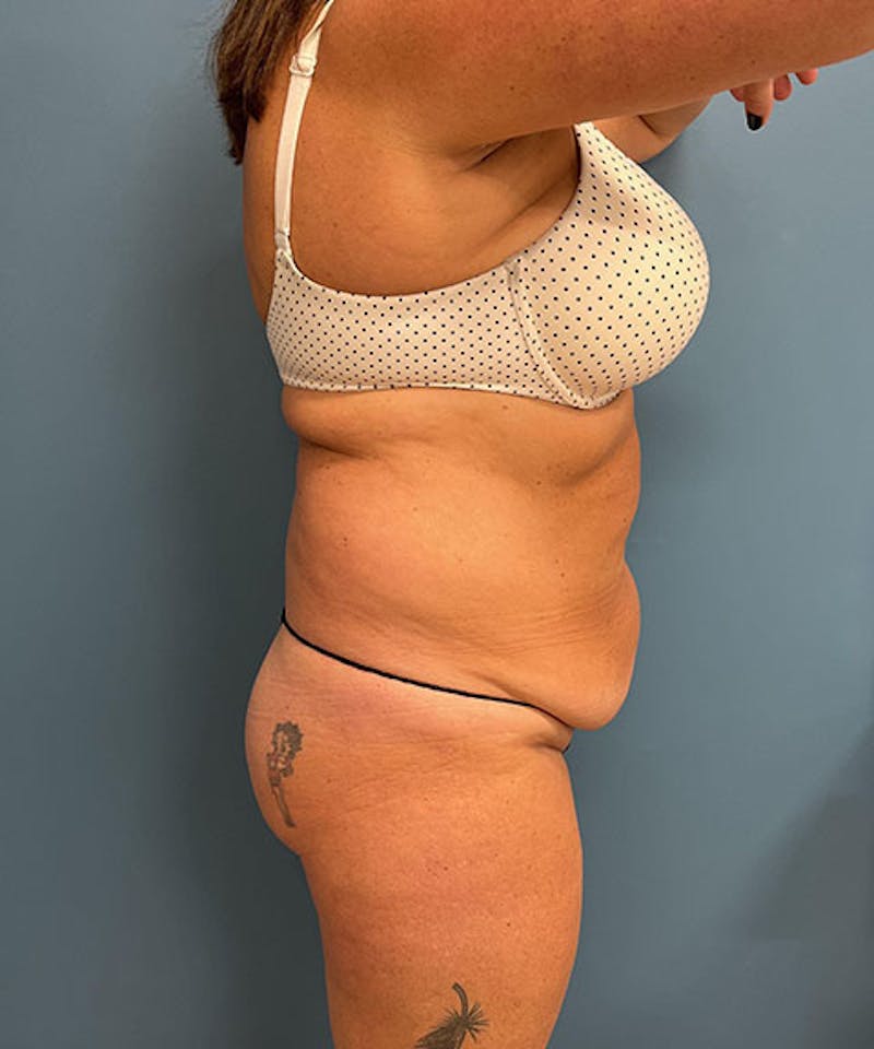 Powertuck Before & After Gallery - Patient 145102 - Image 3