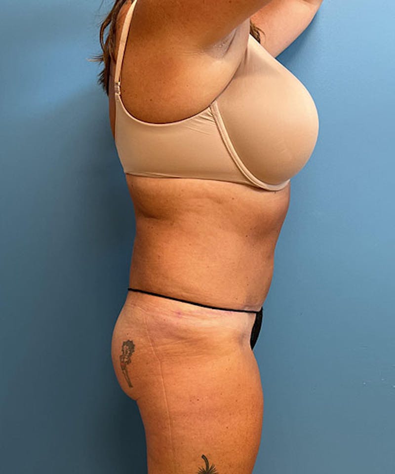 Powertuck Before & After Gallery - Patient 145102 - Image 4