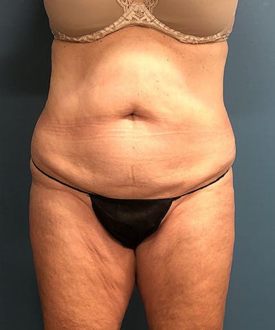 Powertuck Before & After Gallery - Patient 384624 - Image 1