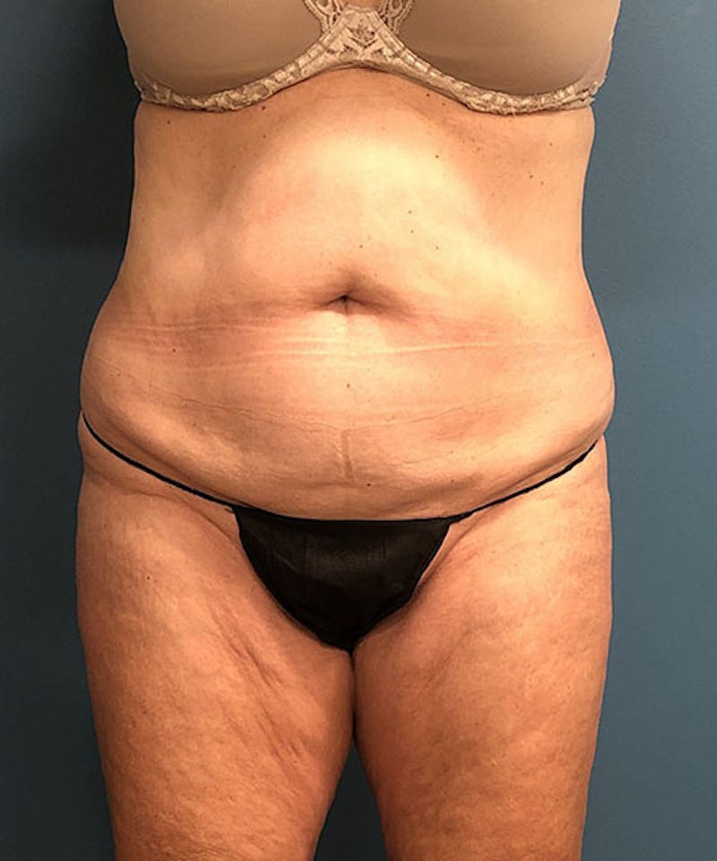 Powertuck Before & After Gallery - Patient 384624 - Image 1