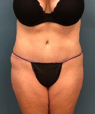 Powertuck Before & After Gallery - Patient 384624 - Image 2