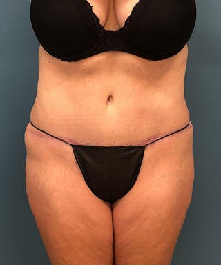 Powertuck Before & After Gallery - Patient 384624 - Image 2
