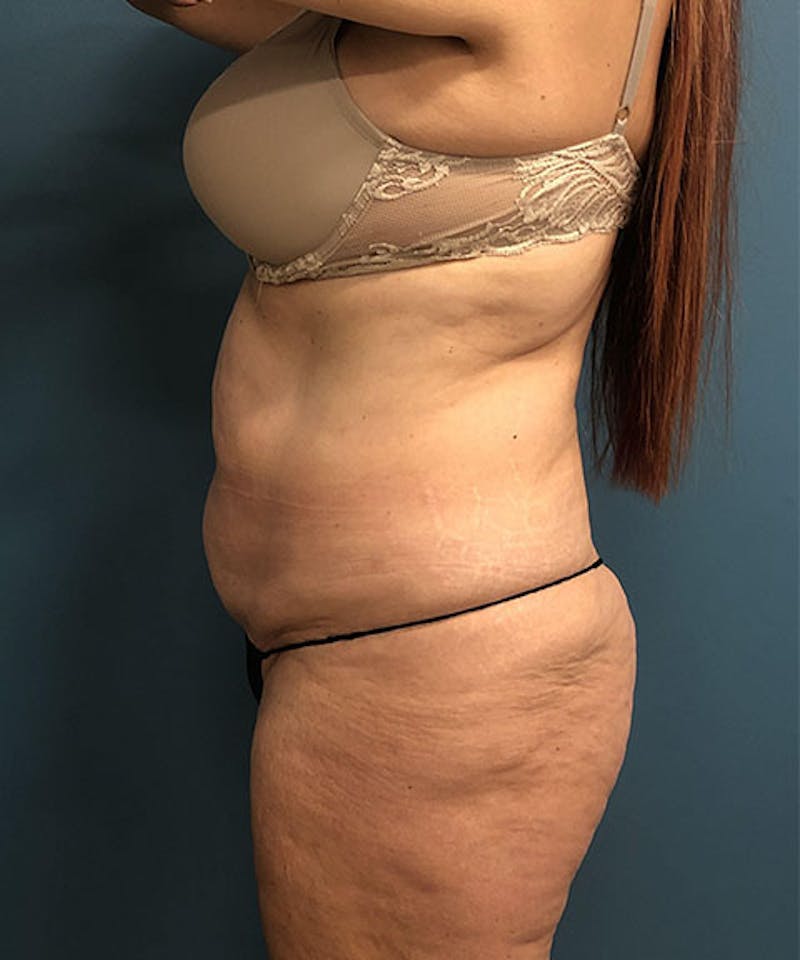Powertuck Before & After Gallery - Patient 384624 - Image 3