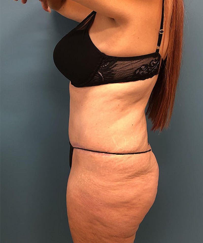 Powertuck Before & After Gallery - Patient 384624 - Image 4