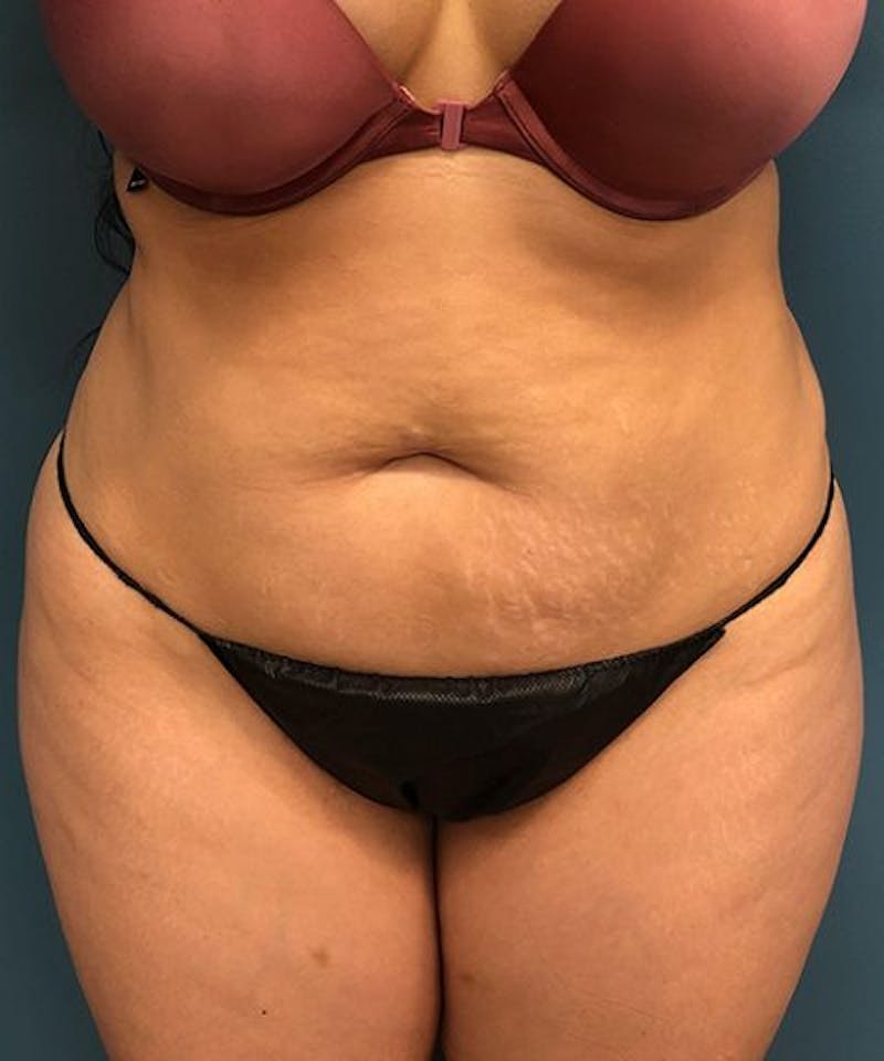 Powertuck Before & After Gallery - Patient 223391 - Image 1