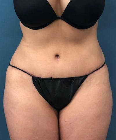 Powertuck Before & After Gallery - Patient 223391 - Image 2