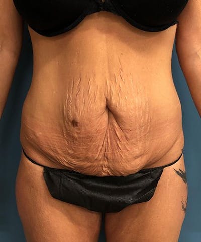 Powertuck Before & After Gallery - Patient 422858 - Image 1