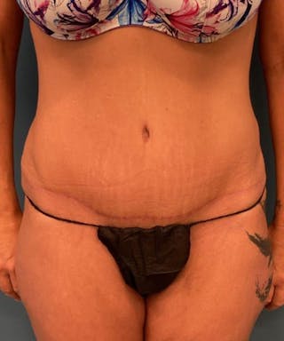 Powertuck Before & After Gallery - Patient 422858 - Image 2