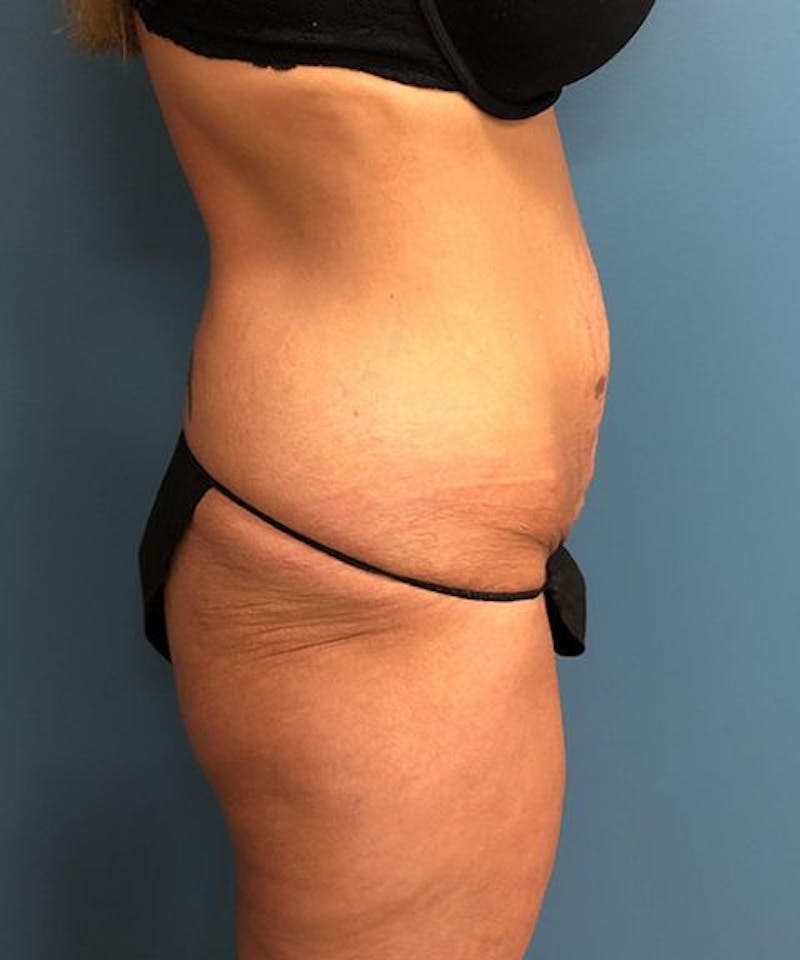 Powertuck Before & After Gallery - Patient 422858 - Image 3