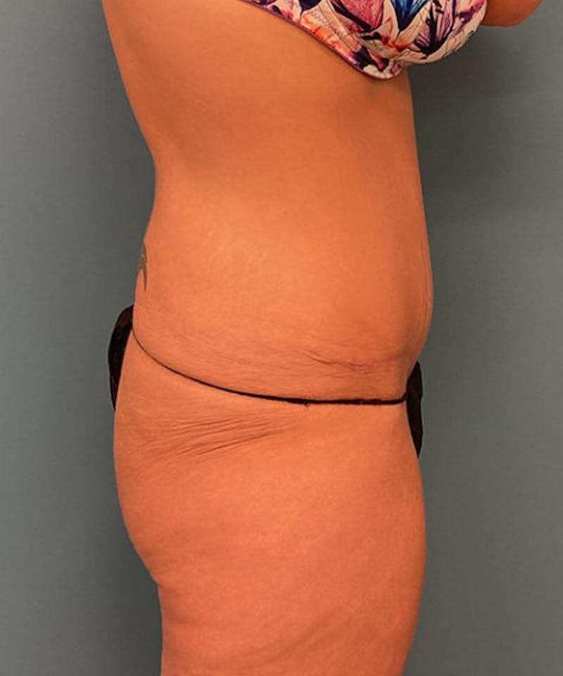 Powertuck Before & After Gallery - Patient 422858 - Image 4