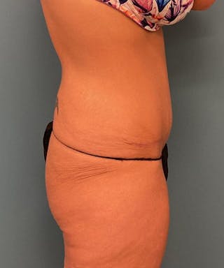 Powertuck Before & After Gallery - Patient 422858 - Image 4