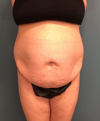 Powertuck Before & After Gallery - Patient 179625 - Image 1