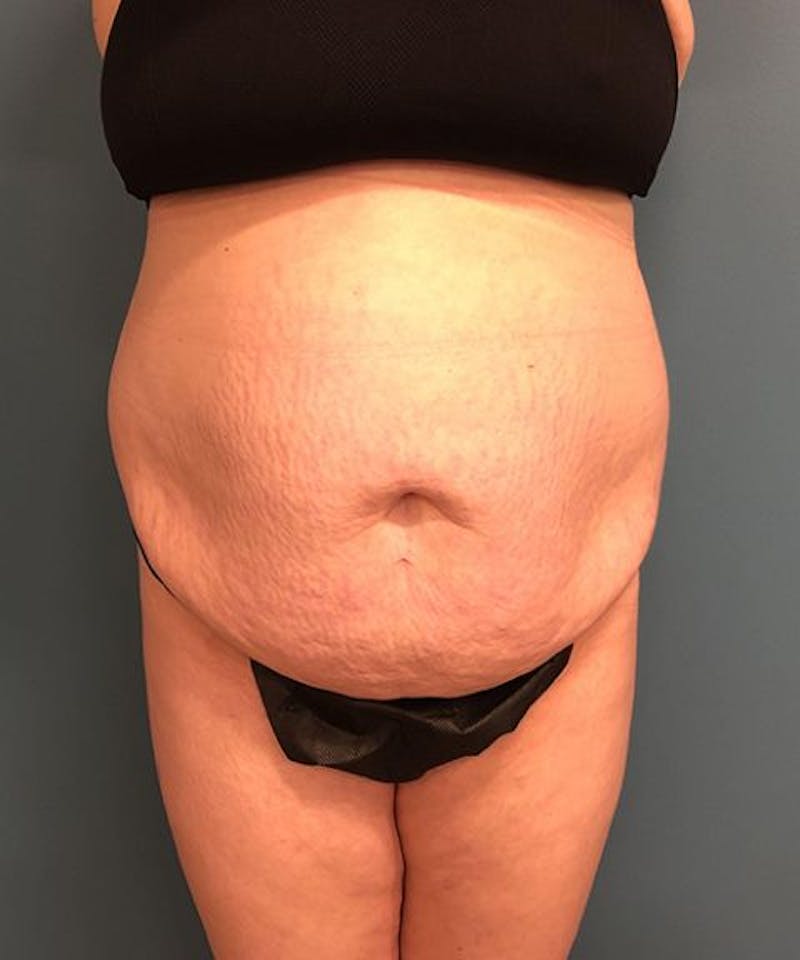 Powertuck Before & After Gallery - Patient 179625 - Image 1