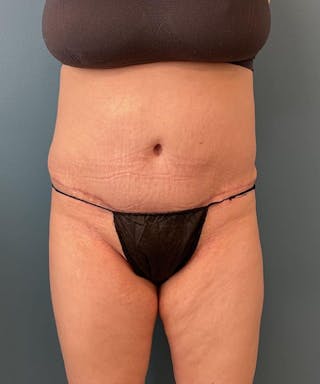 Powertuck Before & After Gallery - Patient 179625 - Image 2