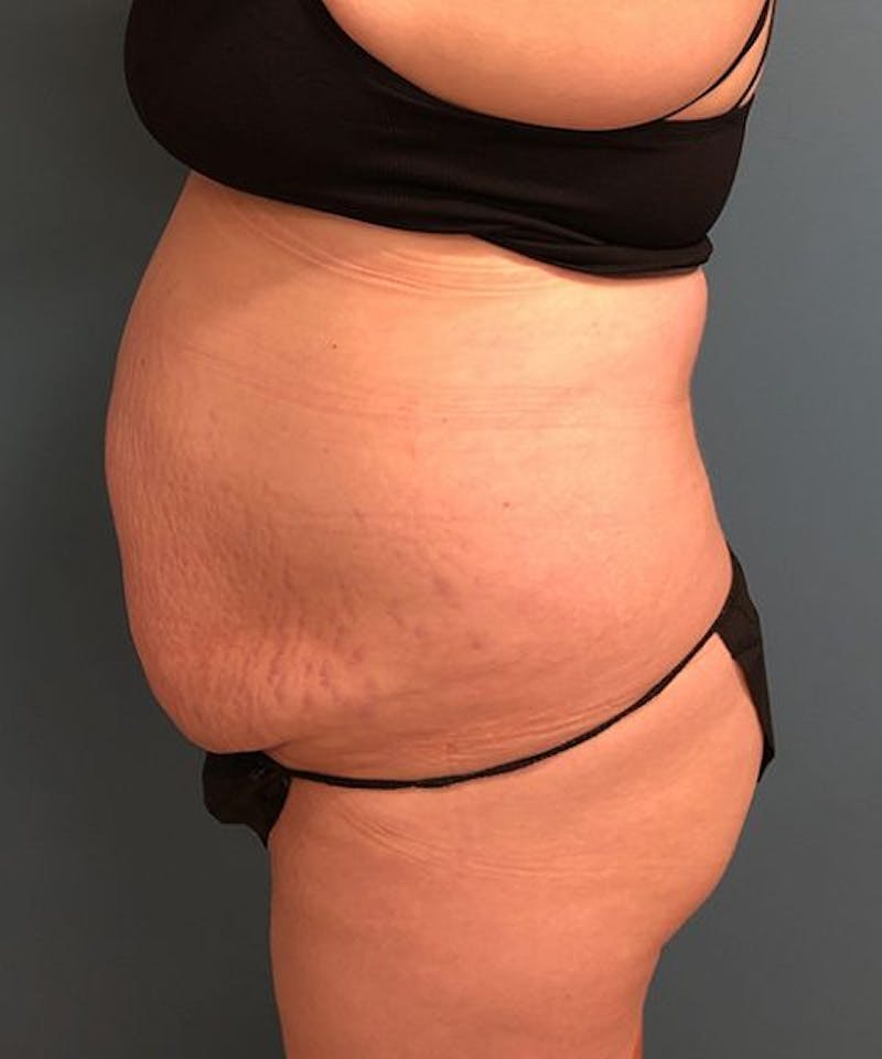 Powertuck Before & After Gallery - Patient 179625 - Image 3