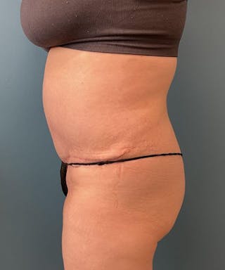 Powertuck Before & After Gallery - Patient 179625 - Image 4