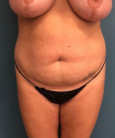 Powertuck Before & After Gallery - Patient 292985 - Image 1