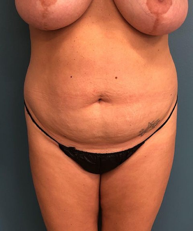 Powertuck Before & After Gallery - Patient 292985 - Image 1