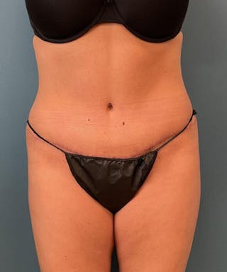 Powertuck Before & After Gallery - Patient 292985 - Image 2