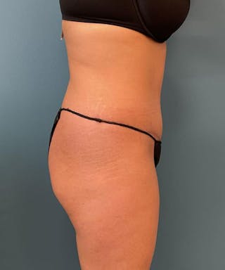 Powertuck Before & After Gallery - Patient 292985 - Image 4