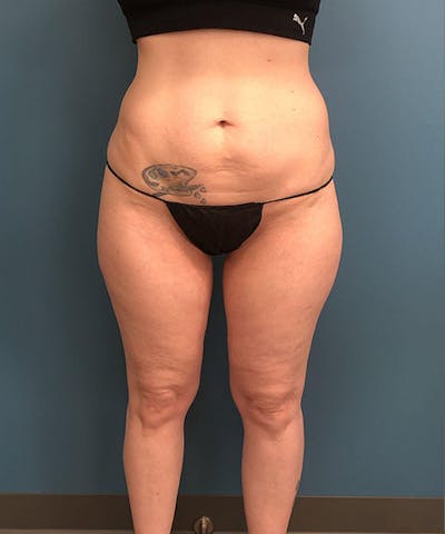 Powertuck Before & After Gallery - Patient 121139 - Image 1