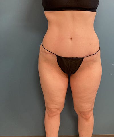 Powertuck Before & After Gallery - Patient 121139 - Image 2
