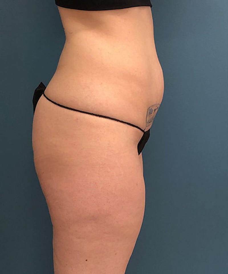 Powertuck Before & After Gallery - Patient 121139 - Image 3