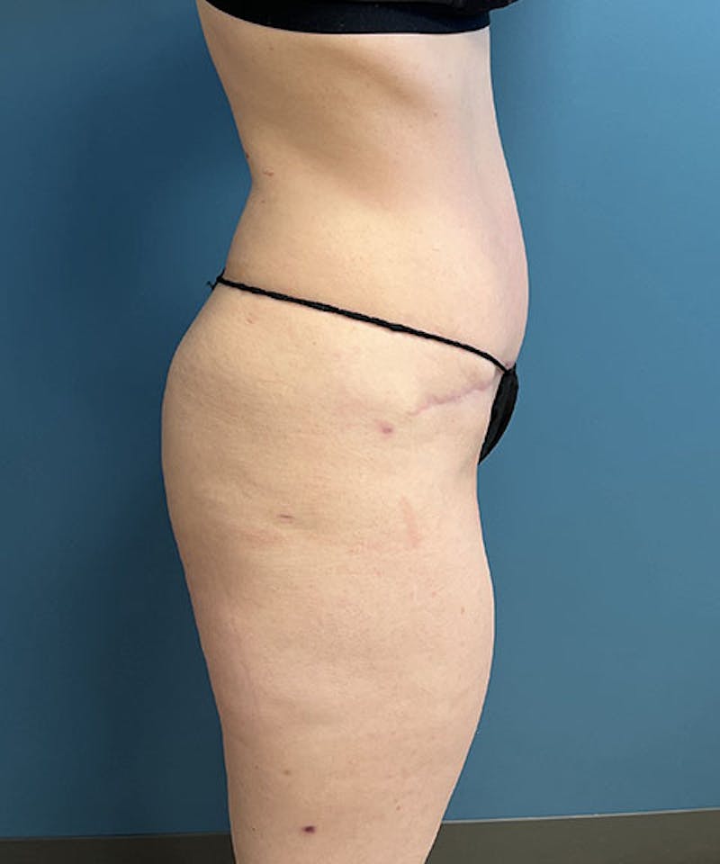 Powertuck Before & After Gallery - Patient 121139 - Image 4