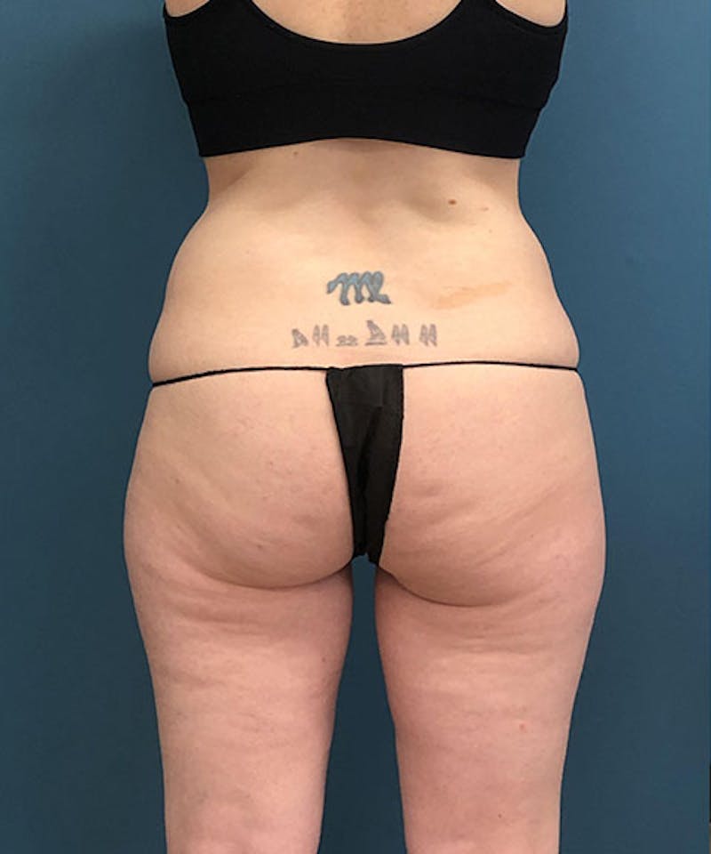 Powertuck Before & After Gallery - Patient 121139 - Image 5