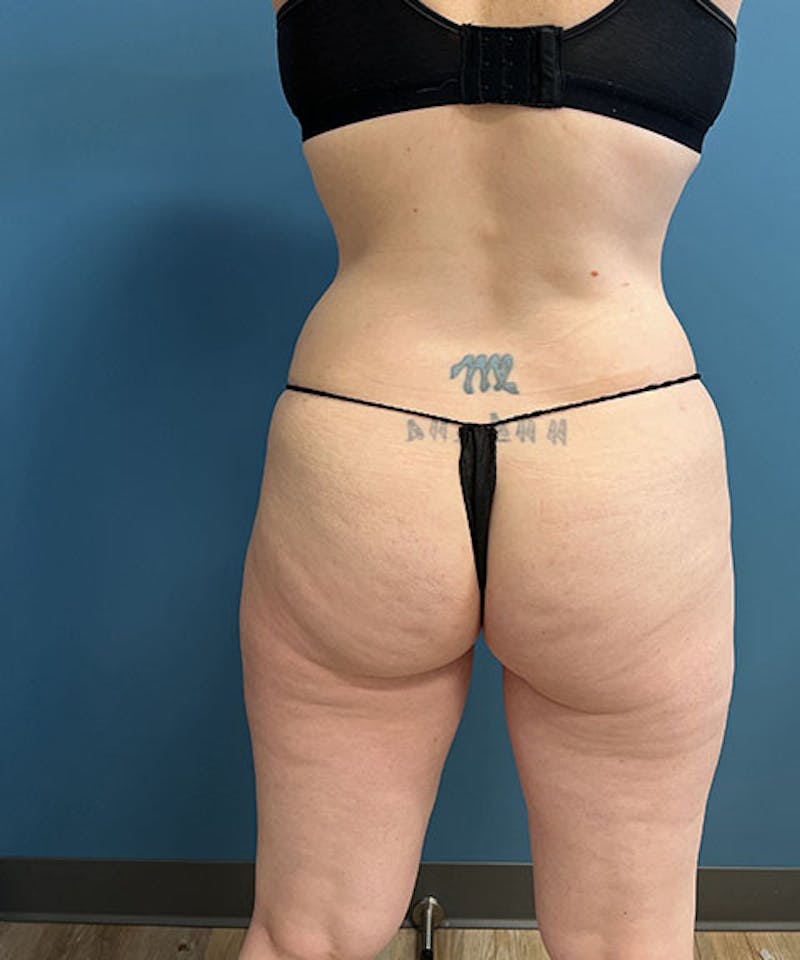 Powertuck Before & After Gallery - Patient 121139 - Image 6