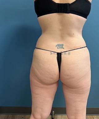 Powertuck Before & After Gallery - Patient 121139 - Image 6