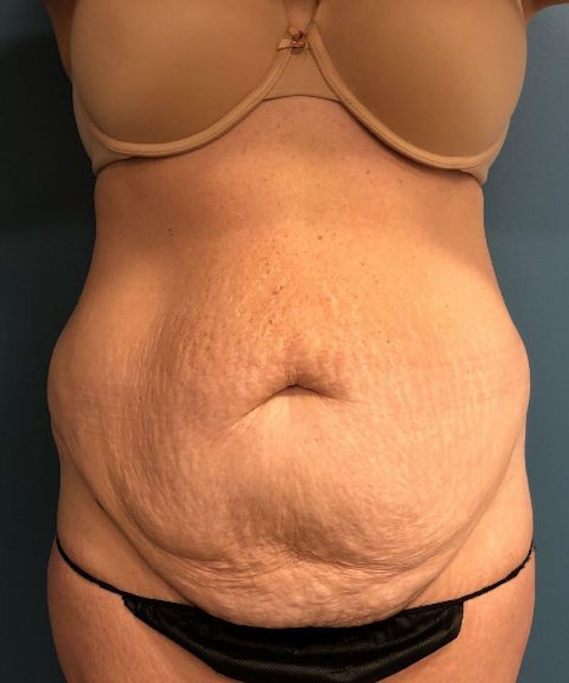 Powertuck Before & After Gallery - Patient 255481 - Image 1