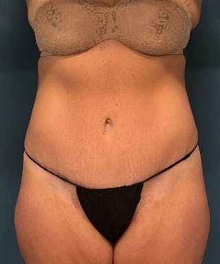 Powertuck Before & After Gallery - Patient 255481 - Image 2