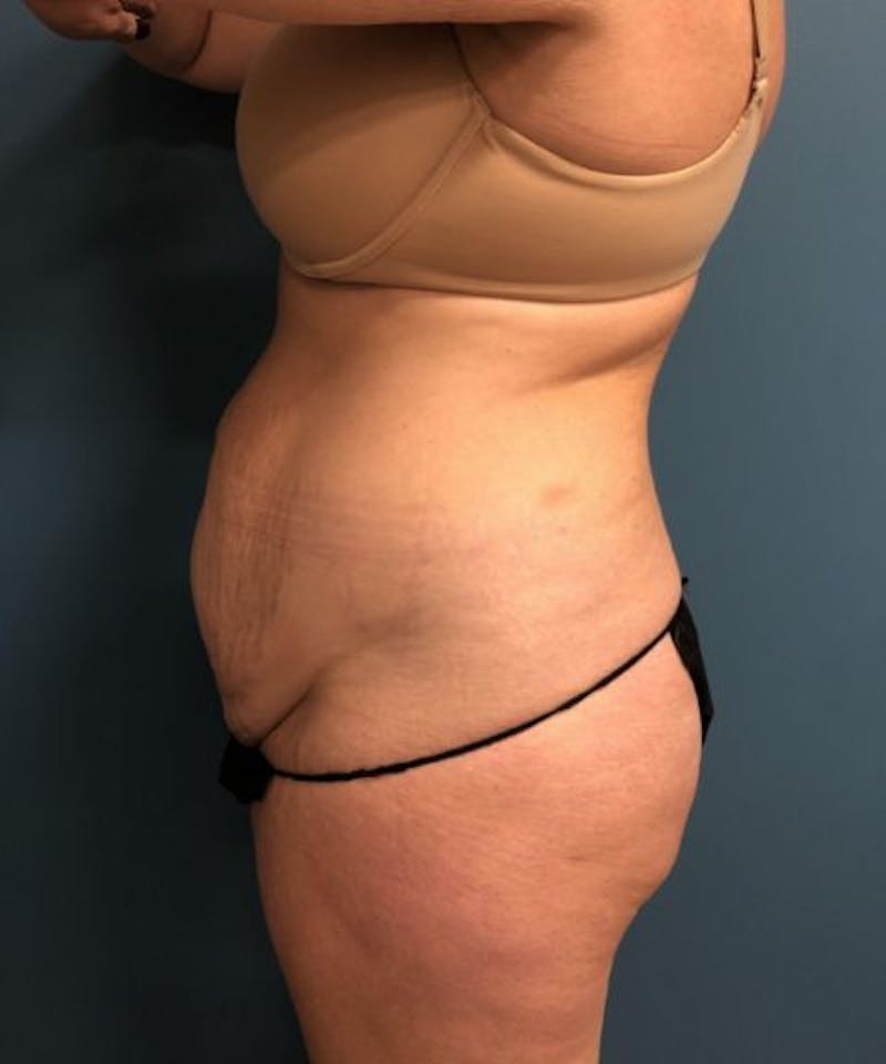 Powertuck Before & After Gallery - Patient 255481 - Image 3