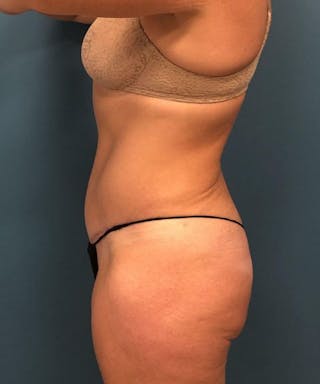 Powertuck Before & After Gallery - Patient 255481 - Image 4