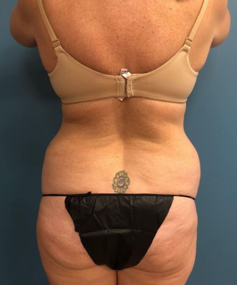 Powertuck Before & After Gallery - Patient 255481 - Image 5