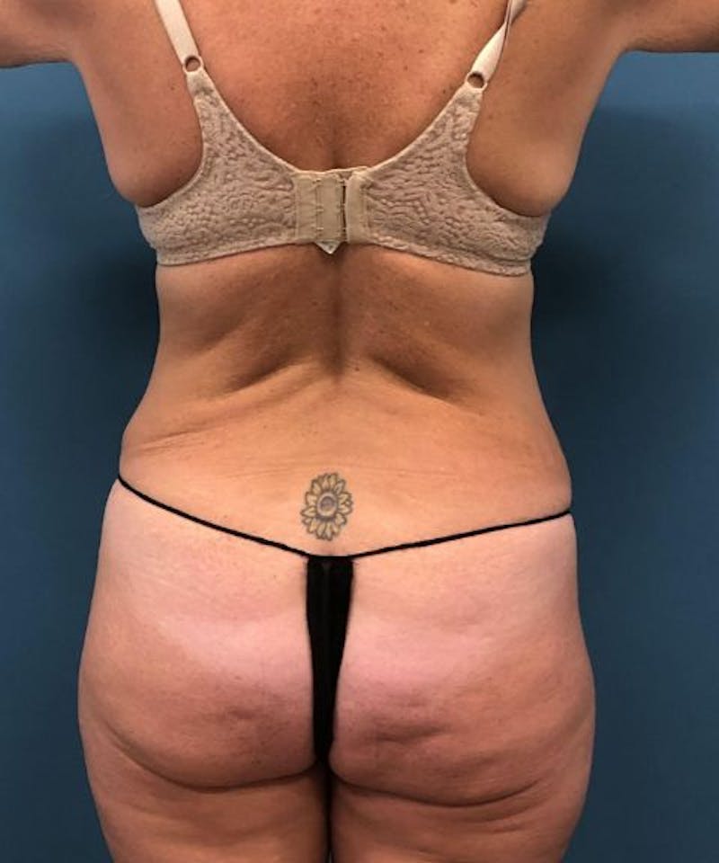 Powertuck Before & After Gallery - Patient 255481 - Image 6