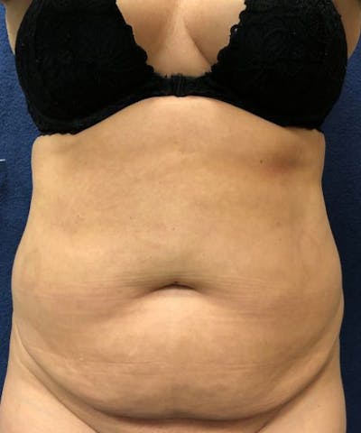 Powertuck Before & After Gallery - Patient 146103 - Image 1