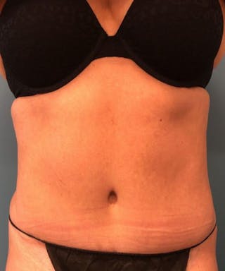 Powertuck Before & After Gallery - Patient 146103 - Image 2