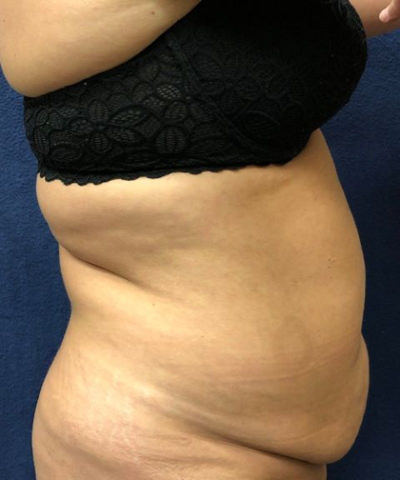 Powertuck Before & After Gallery - Patient 146103 - Image 3