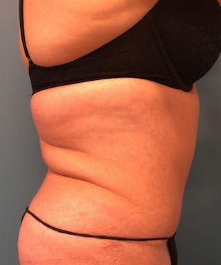 Powertuck Before & After Gallery - Patient 146103 - Image 4