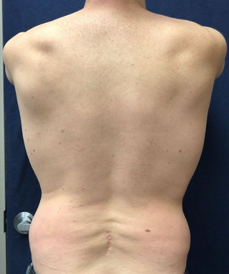 Powertuck Before & After Gallery - Patient 265390 - Image 5