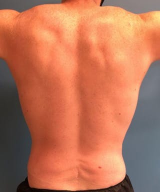 Powertuck Before & After Gallery - Patient 265390 - Image 6