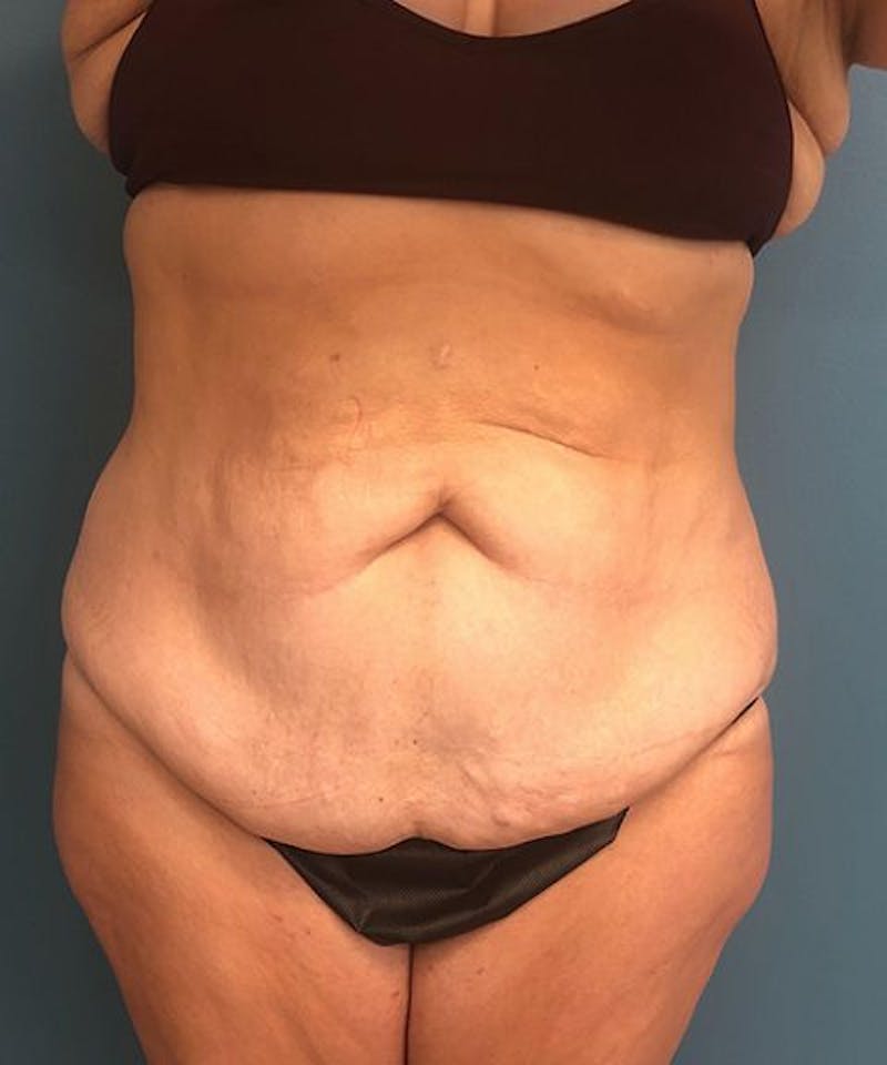 Powertuck Before & After Gallery - Patient 391154 - Image 1