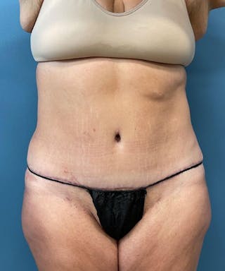 Powertuck Before & After Gallery - Patient 391154 - Image 2