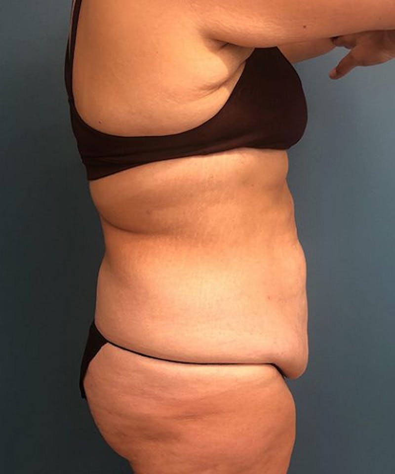 Powertuck Before & After Gallery - Patient 391154 - Image 3