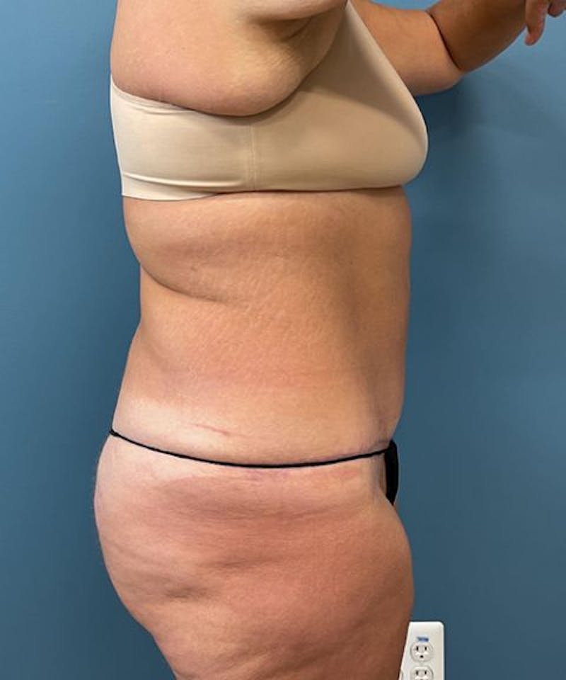 Powertuck Before & After Gallery - Patient 391154 - Image 4
