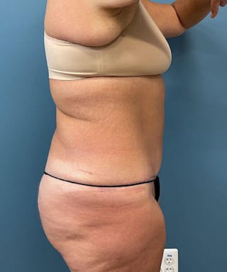 Powertuck Before & After Gallery - Patient 391154 - Image 4