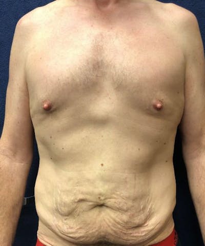 Powertuck Before & After Gallery - Patient 239148 - Image 1